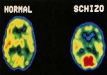 Установлена причина шизофрении и аутизма
