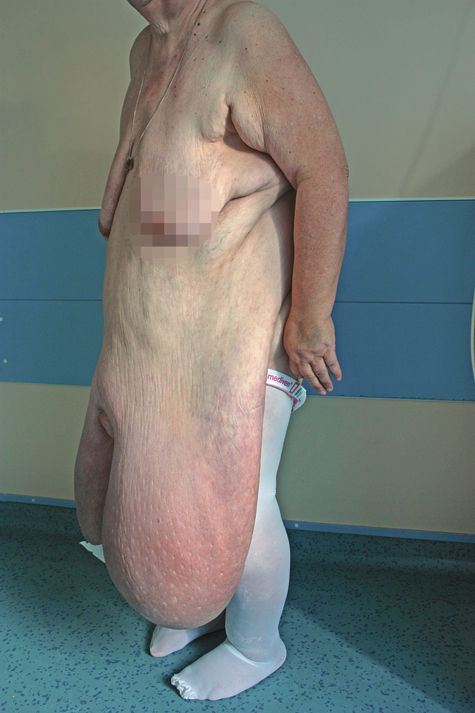 Столичные хирурги убрали пациентке живот весом 35 кг