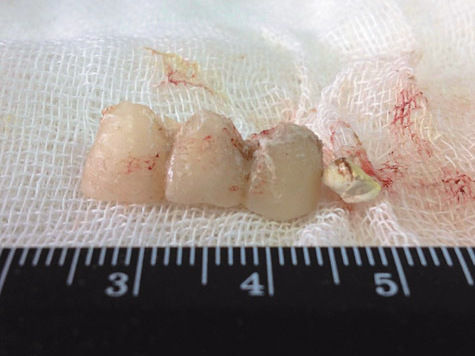 Зубной протез вдохнула во сне 30-летняя жительница Подмосковья