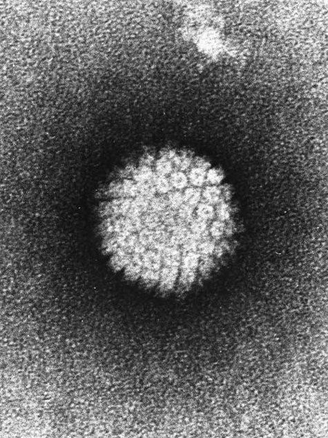 Gégerákot is okozhat a HPV