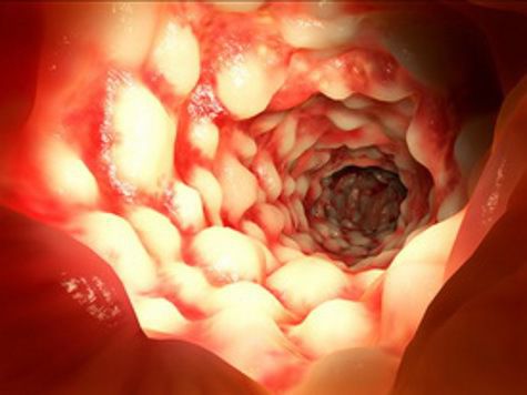 Метод «фекальной трансплантации» вызвал пристальный интерес чиновников
