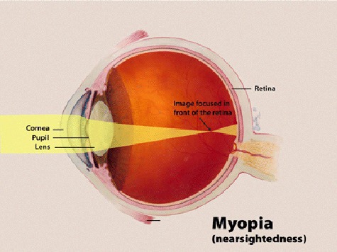 Специальные линзы позволяют детскому глазу расти так, что зрение становится нормальным