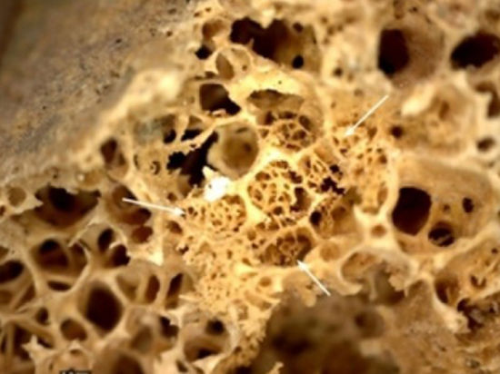 Мумия онкобольного была обнаружена в ходе раскопок в северном Судане