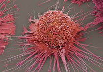 Ученые перепрограммировали клетки рака в макрофаги, которые уничтожают бактерии