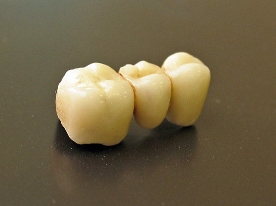 Потеря зубов отражает состояние психического и физического здоровья в пожилом возрасте, особенно в 60-75 лет 