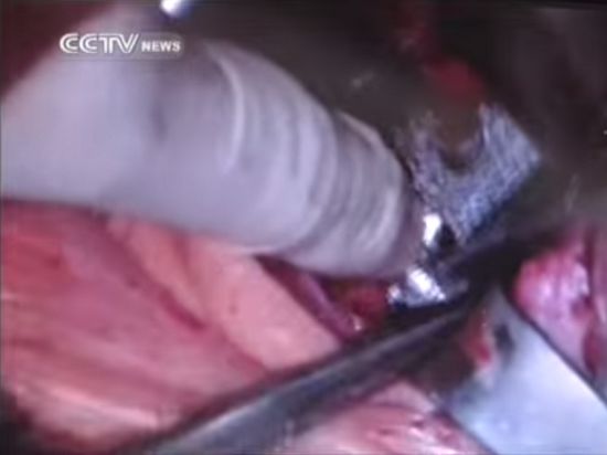 В ходе обширной пятичасовой операции двенадцатилетнему мальчику был удалён второй шейный позвонок, а на его место вживлён 3D-имплантат
